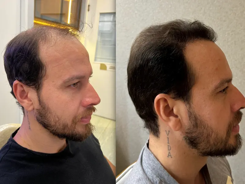 Antes e depois de transplante capilar FUE em vista lateral, Instituto Dr. Maxwell Pereira, São Luís