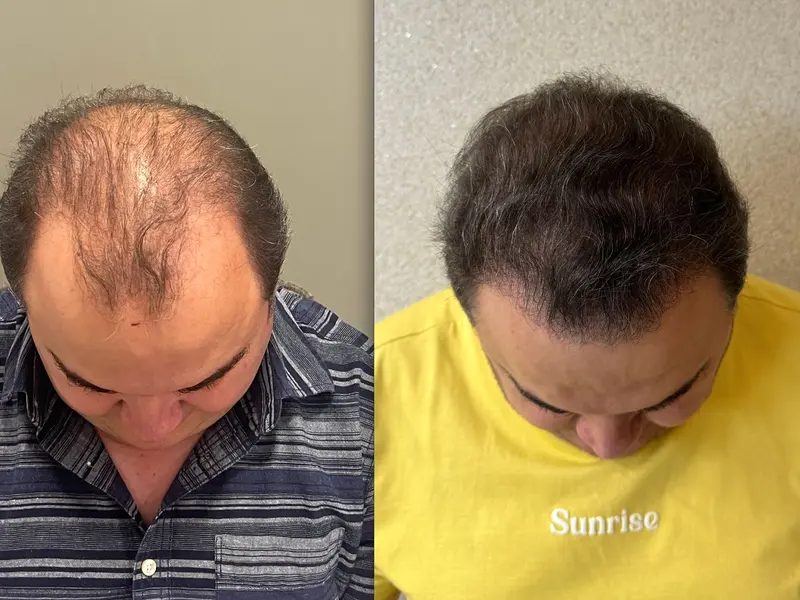 Antes e depois de transplante capilar FUE em vista superior, Instituto Dr. Maxwell Pereira, São Luís